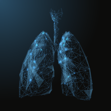 Great Strides Drive Progress Toward Precision Medicine in Lung Cancer Therapy