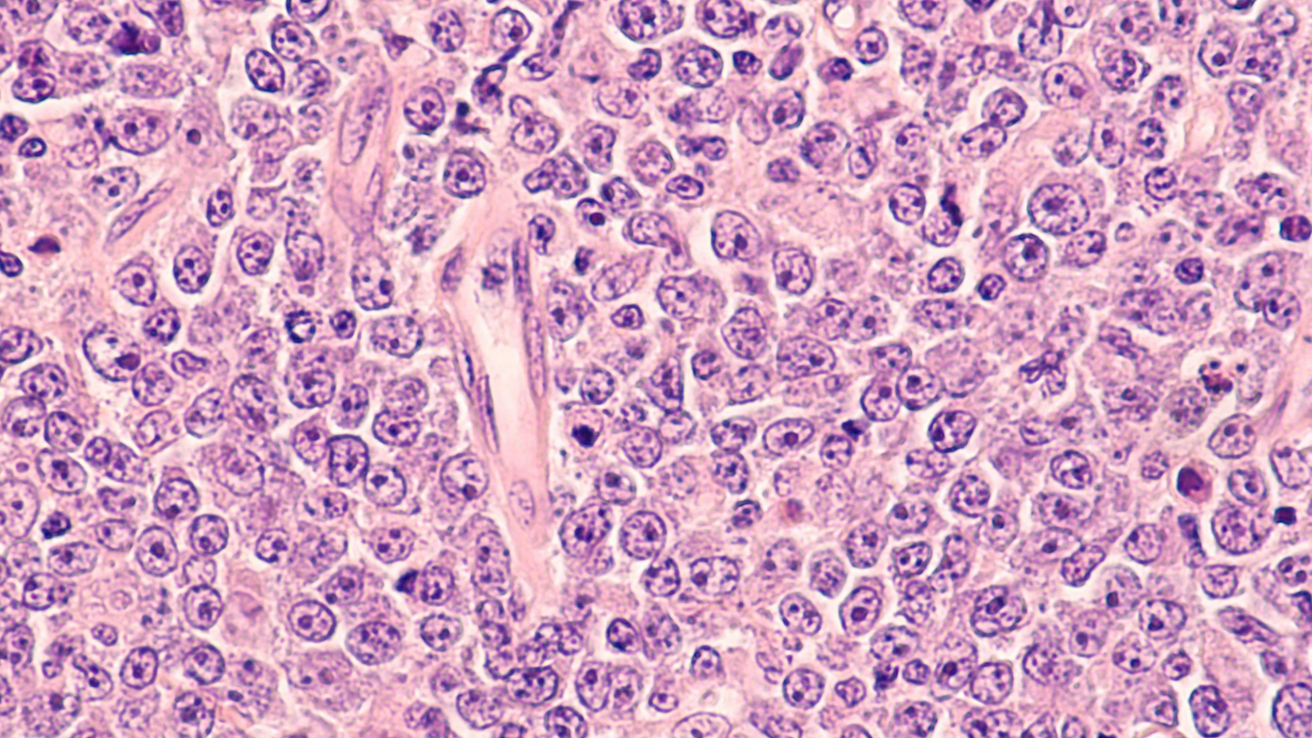 Photomicrograph of a diffuse large B-cell lymphoma (DLBCL) a type of non-Hodgkin lymphoma | Image Credit: David A Litman - stock.adobe.com