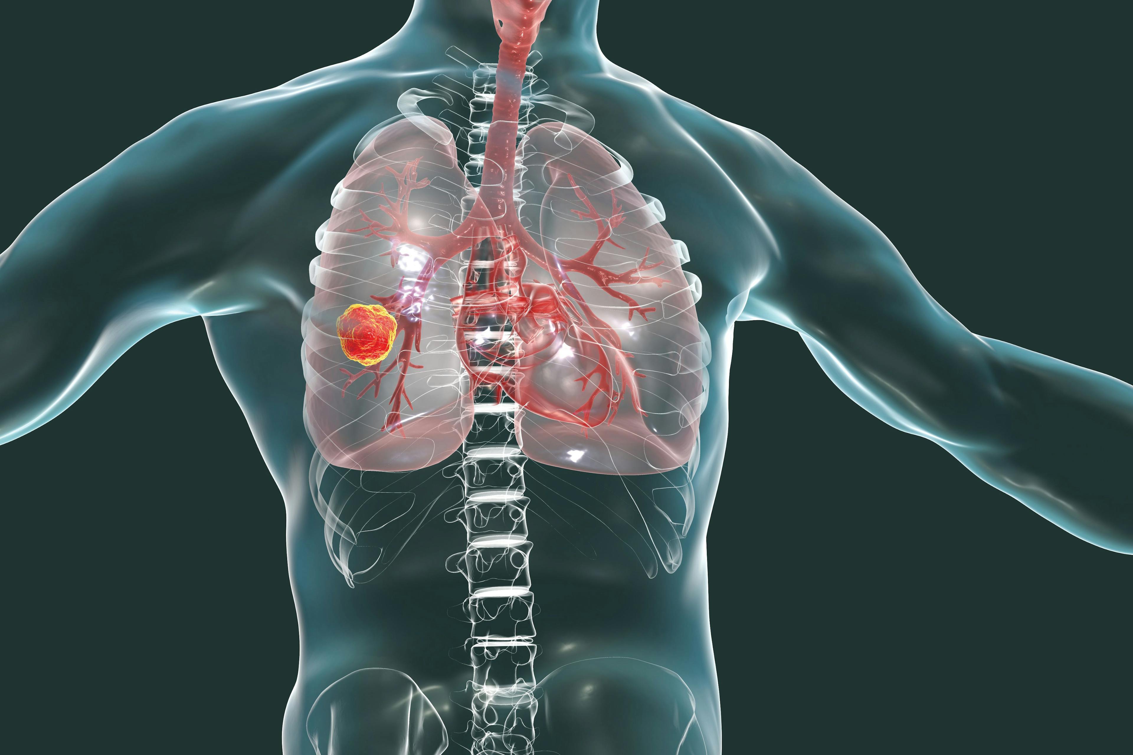 FDA Approves FoundationOne CDx for Use With Entrectinib For NSCLC, Solid Tumors