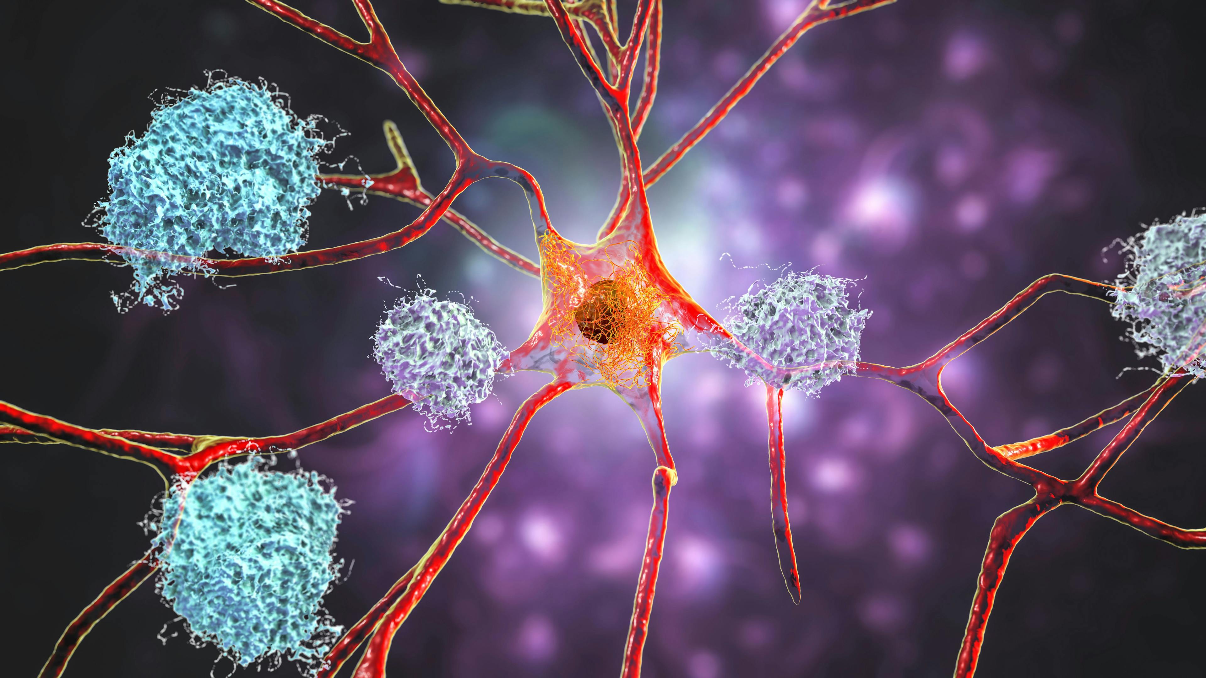 Neurons in Alzheimer's disease. | Image Credit: Dr_Microbe - stock.adobe.com