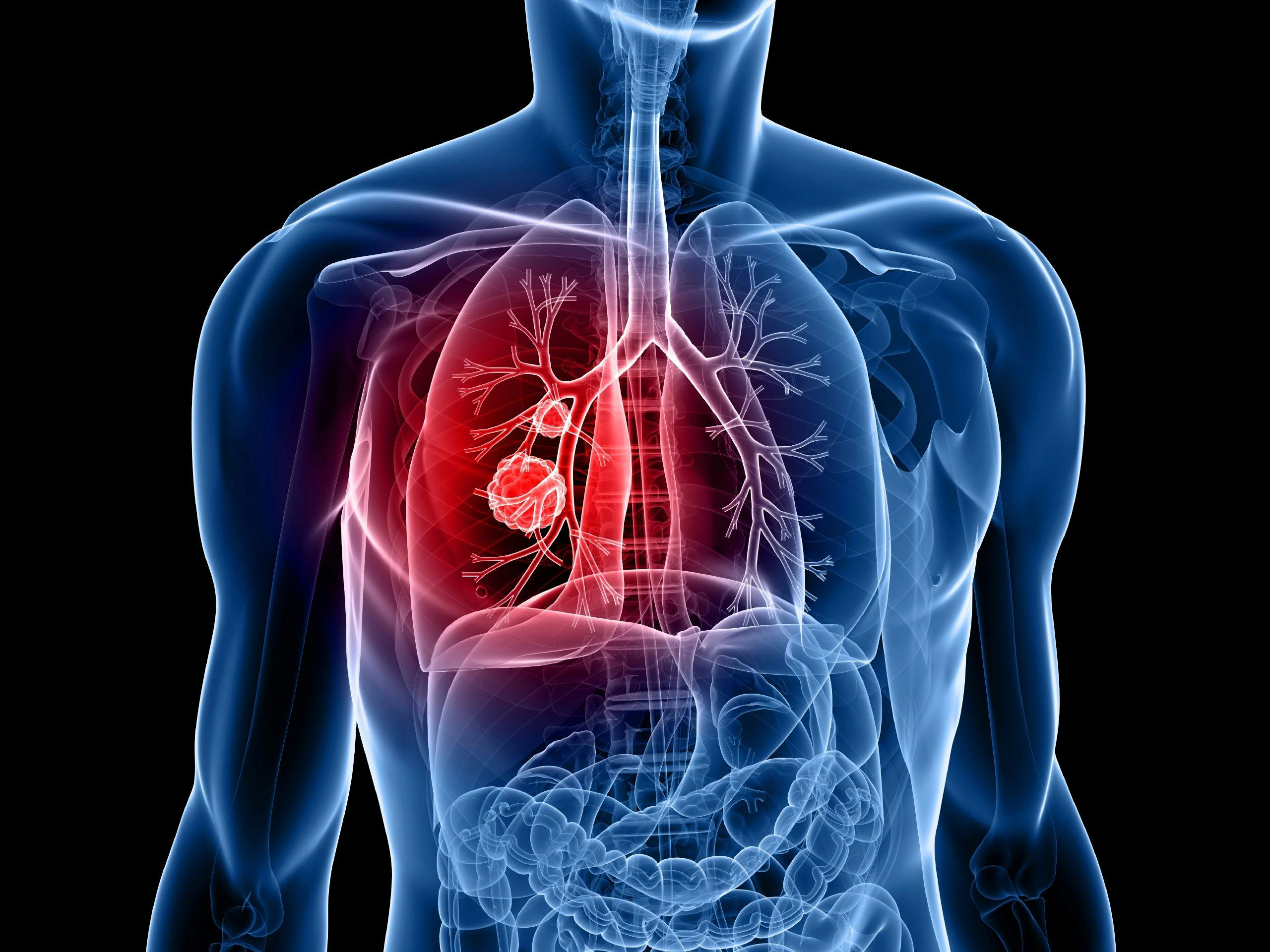 Genentech’s Subcutaneous Tecentriq Demonstrates Positive Phase 3 Results for NSCLC