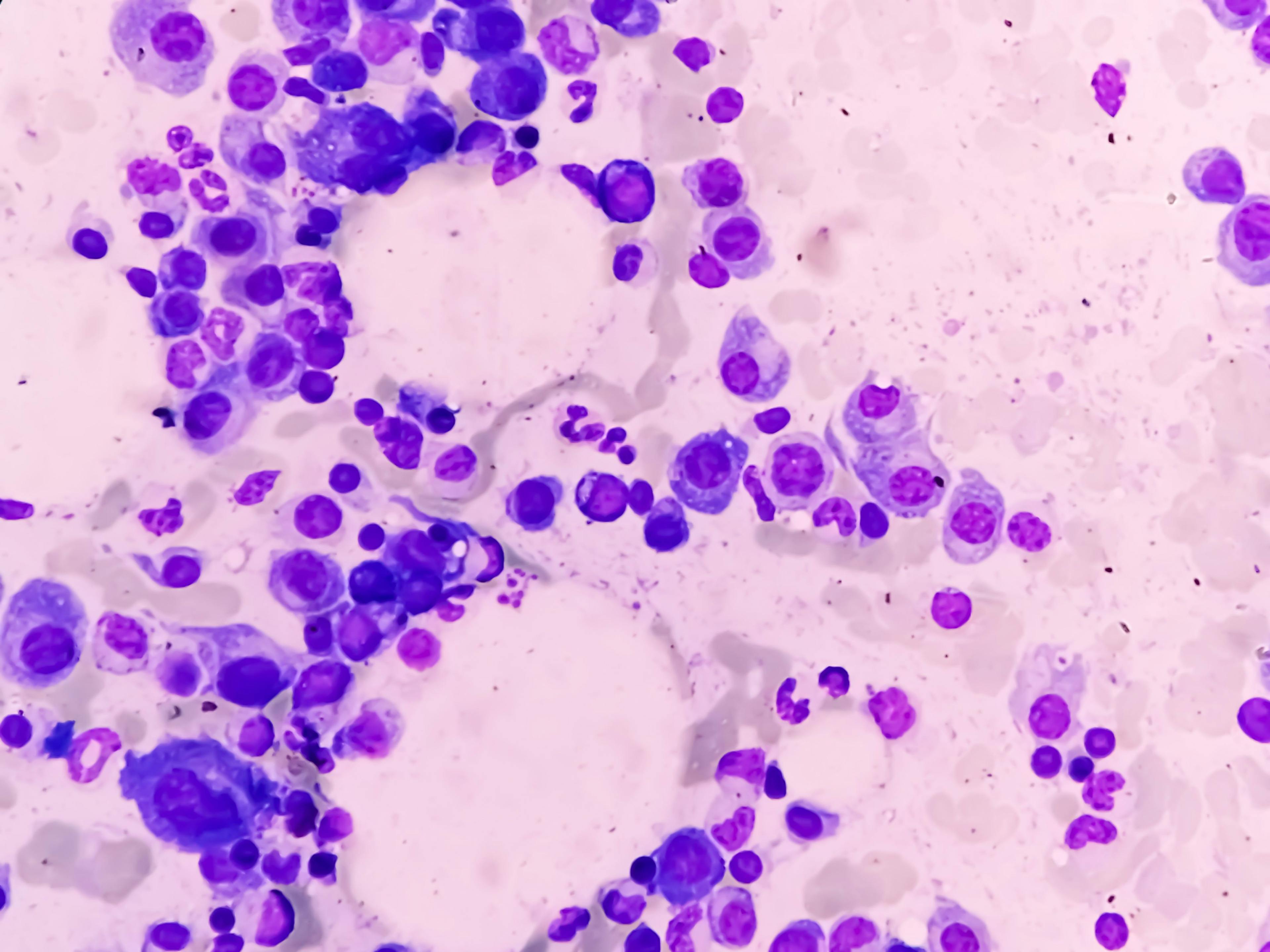 Microscopic view of bone marrow, multiple myeloma