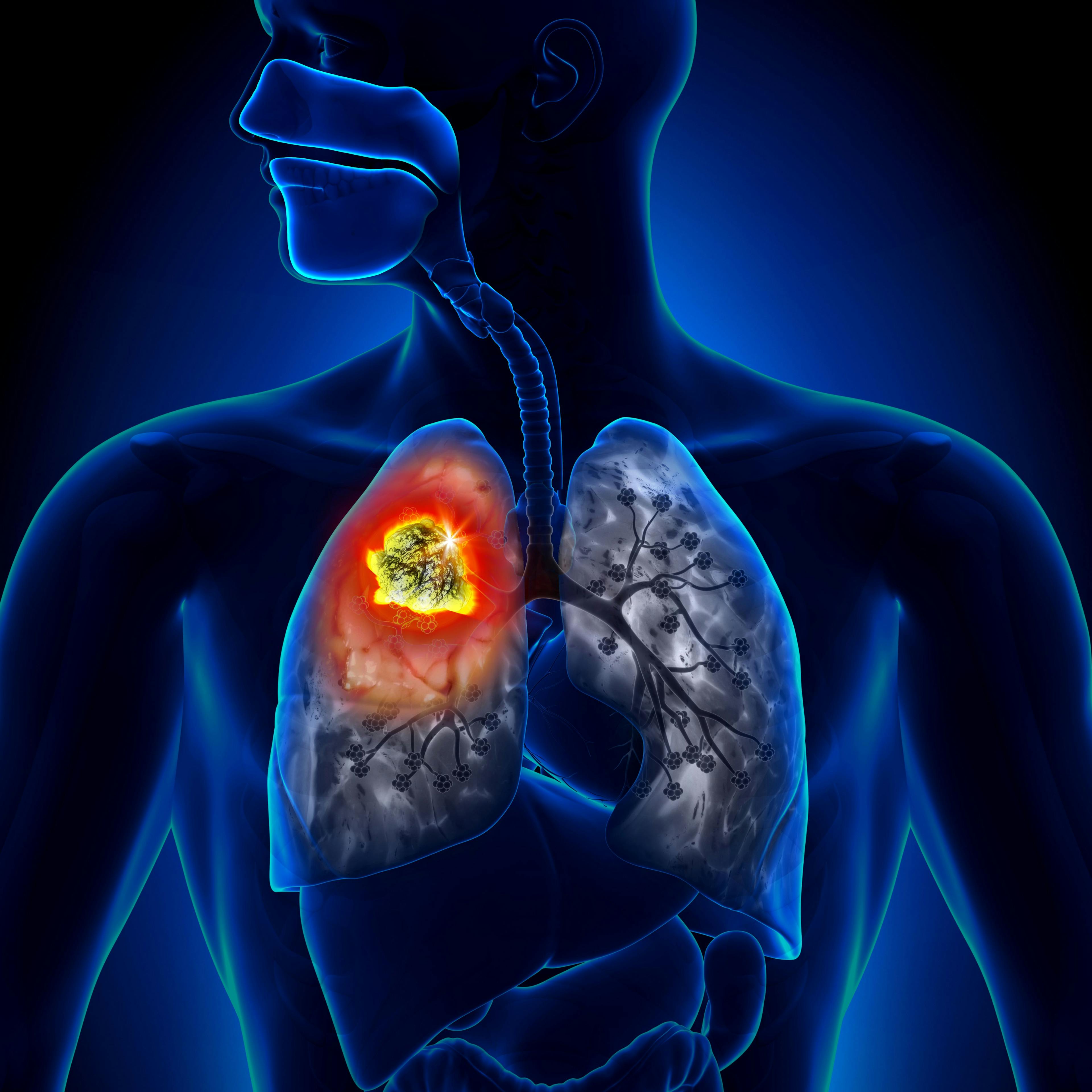 Study: Overall Patient Survival Estimates for NSCLC Are Transferable From US to Canada
