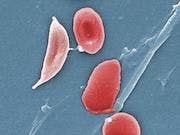 Sickle Cell Disease Treatment Granted Breakthrough Therapy Designation
