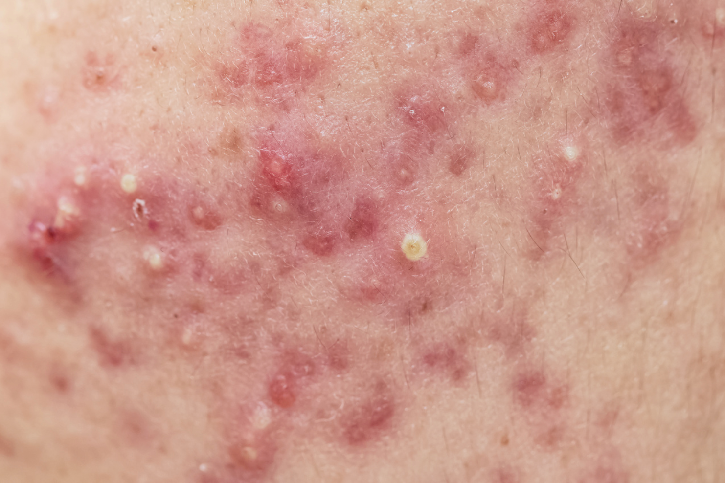 Clinical Overview: Isotretinoin (Absorica) for Severe Recalcitrant Nodular Acne