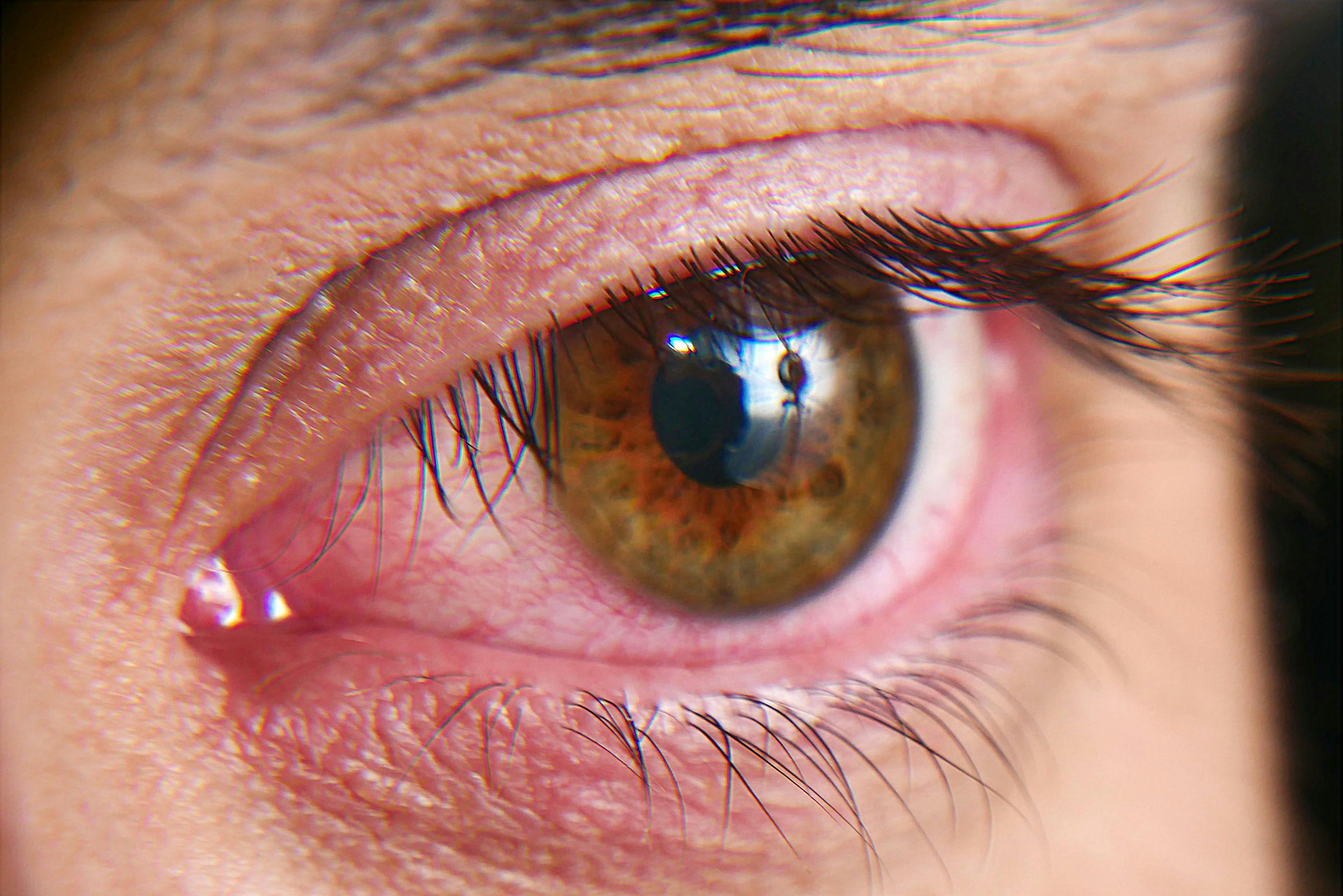 Red squirrel eyes, macro photo. Conjunctivitis, eye disease - Image credit: Kryuchka Yaroslav | stock.adobe 