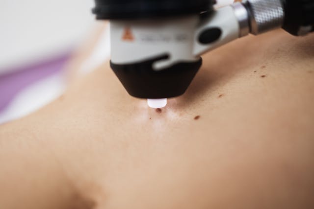 Dermatology skin check up with digital deramatoscope