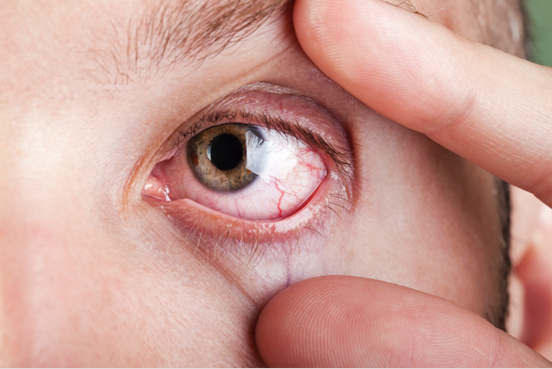 The Pharmacist Role in Customized Solutions for Patients with Dry Eye Disease