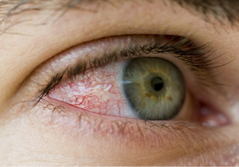 Eye Drops: Treatment Options and Infection Risks