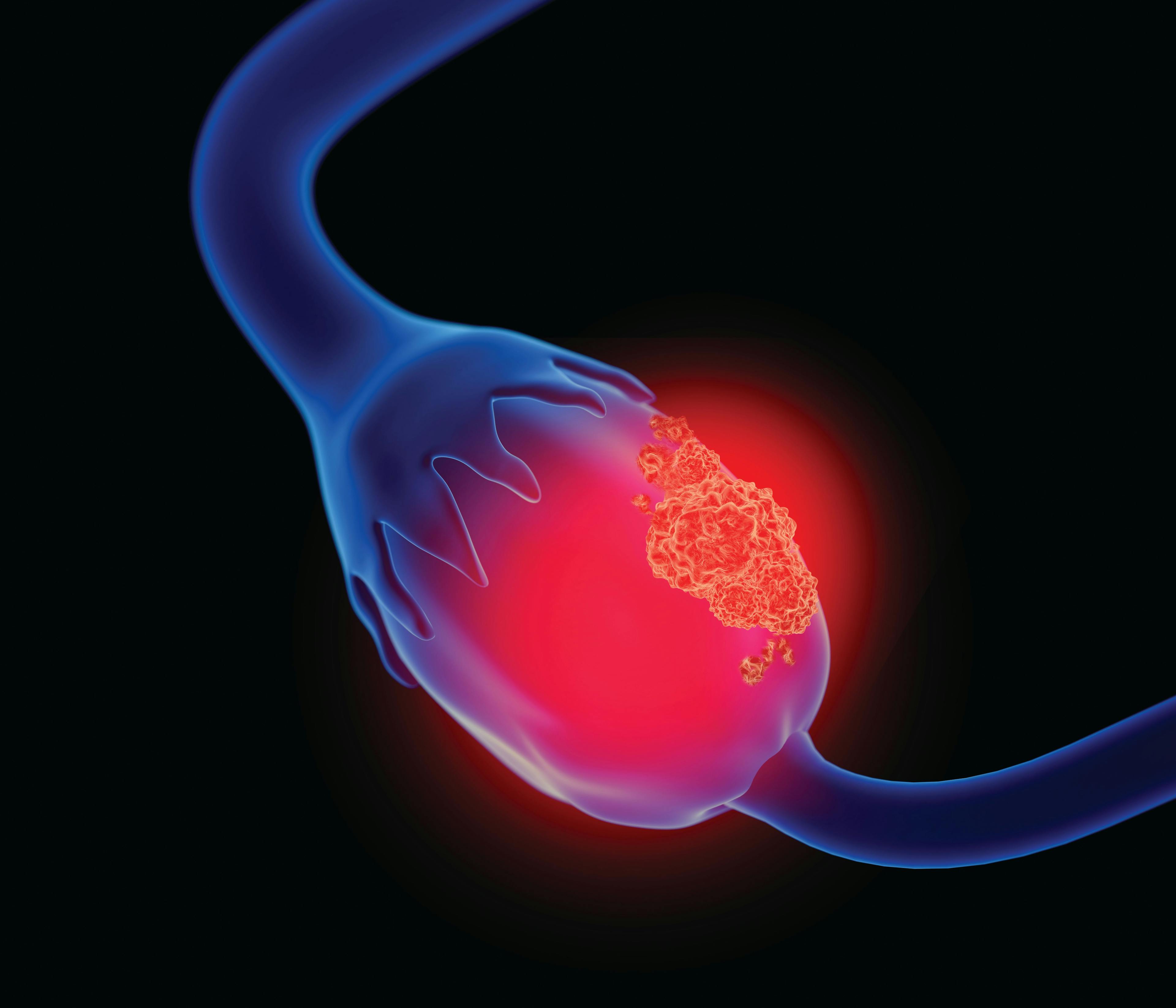 Novel Assay Helps Identify Appropriate Monitoring, Immunotherapy for Patients With Ovarian Cancer