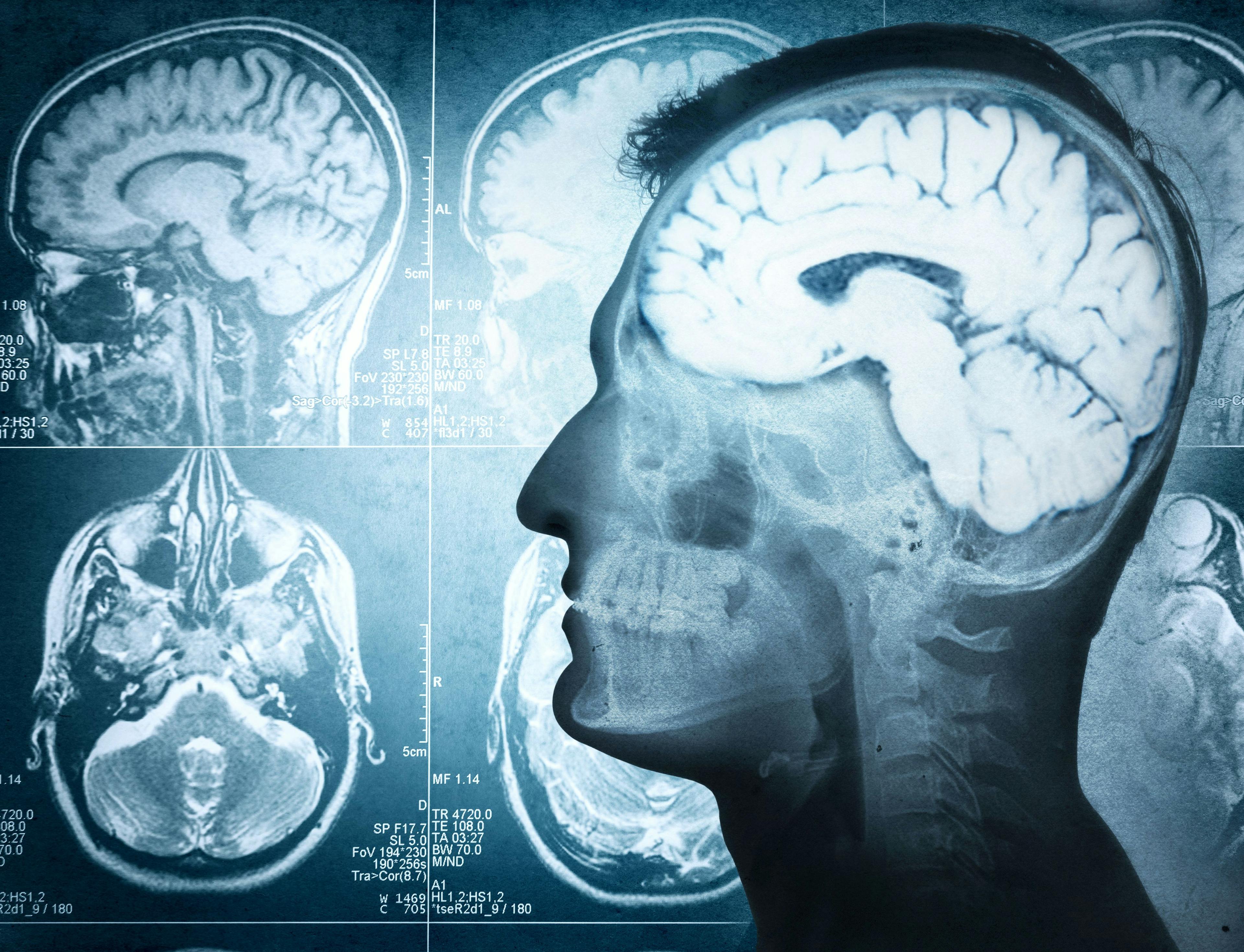 X-ray of brain -- Image credit: Tryfonov | stock.adobe.com