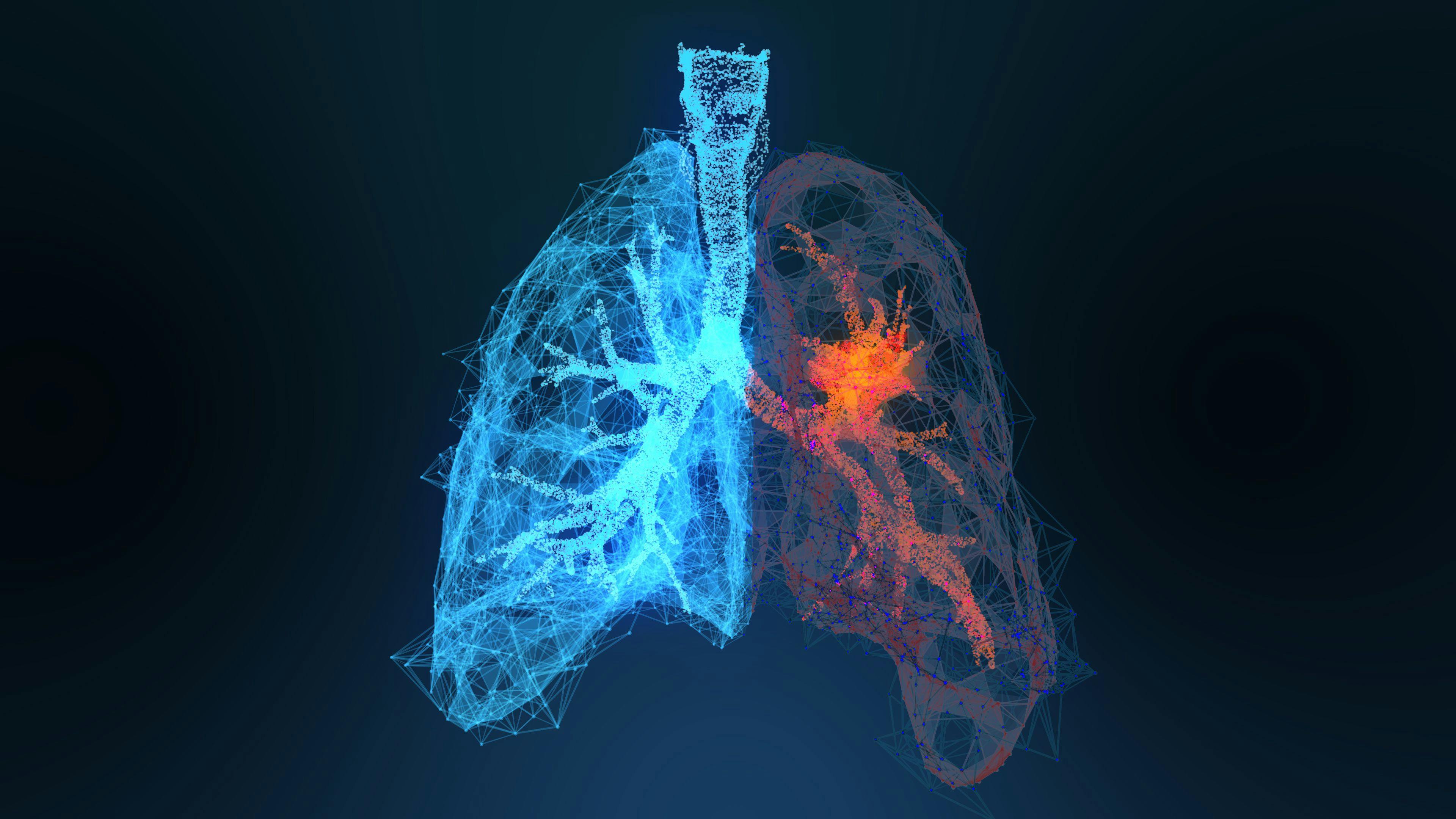 3d rendered illustration of lung cancer 3D illustration. Credit: appledesign - stock.adobe.com