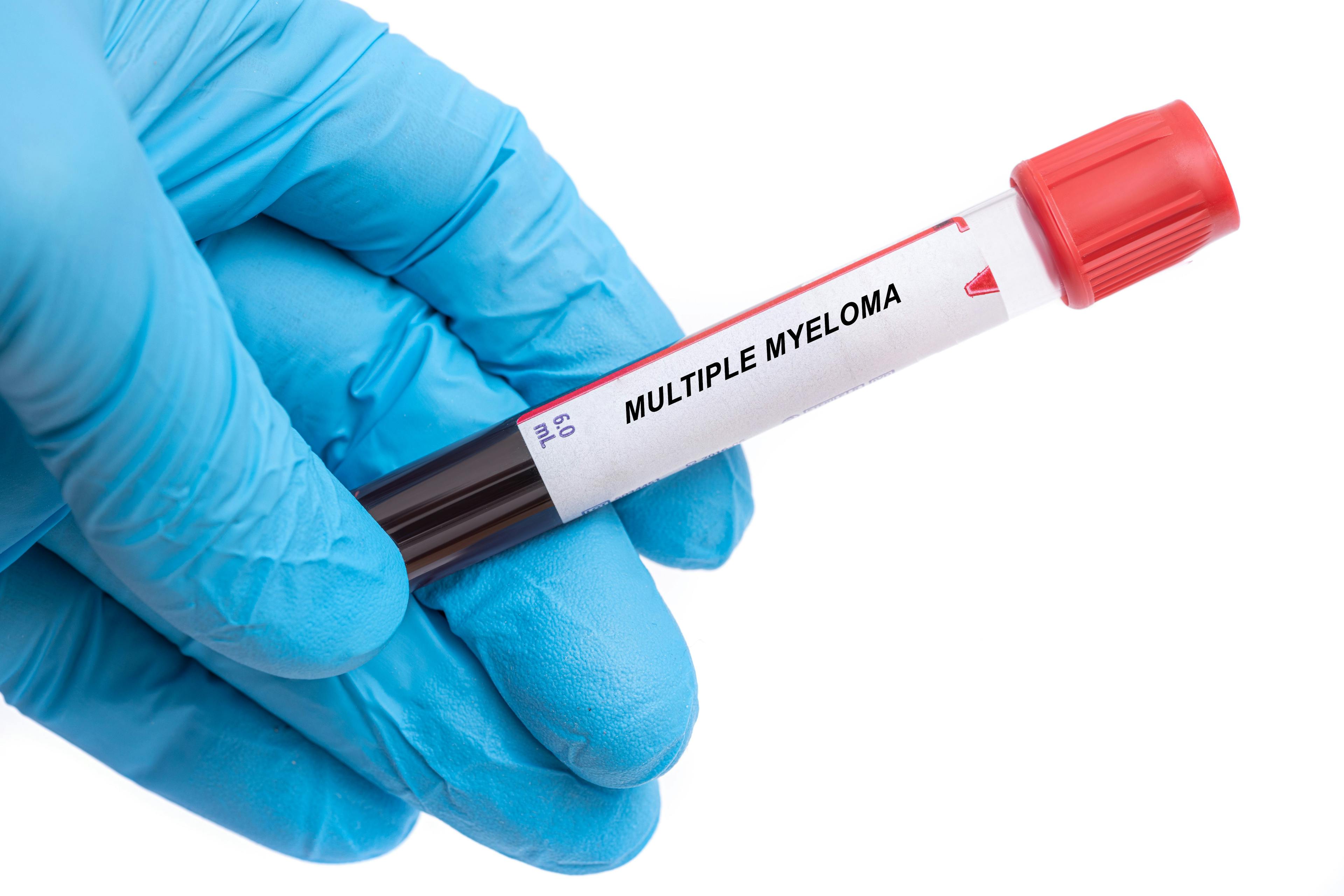 Multiple myeloma blood test in health care worker's hand -- Image credit: luchschenF | stock.adobe.com