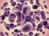 New Drug Class Causes Cell Death in Blood Cancers