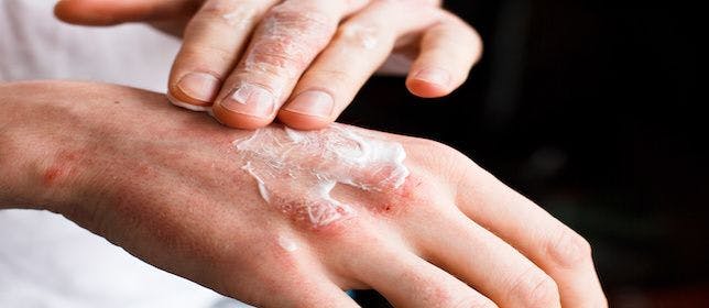 Patients Frequently Use Complementary, Alternative Medicines for Psoriasis When Other Therapies Fail