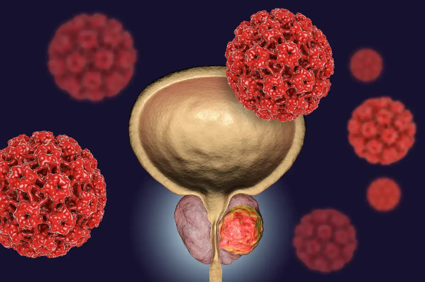 Prostate Cancer Requires Aggressive and Early Treatment