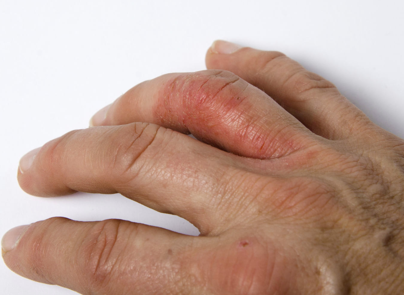 Rates of Hand Eczema Among Health Care Workers Grew During COVID-19 Pandemic