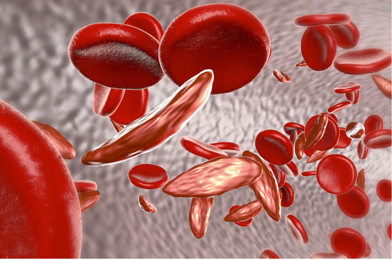 World Sickle Cell Day: The Pharmacist’s Role in Medication Management 