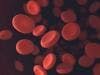 FDA Approves New Treatment for Refractory Multiple Myeloma