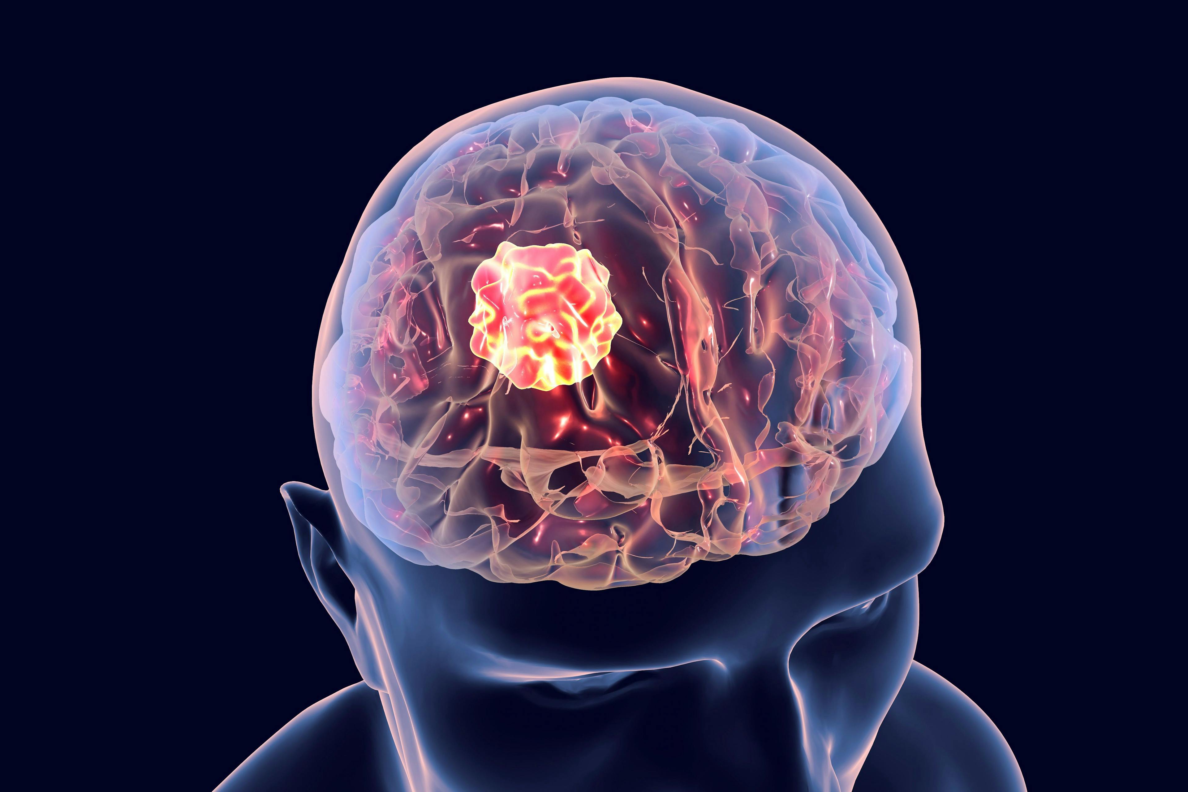 Brain cancer, 3D illustration showing presence of tumor inside brain. Credit: Dr_Microbe - stock.adobe.com