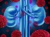 Atezolizumab, Bevacizumab Combination Lessened Mortality Risk for Kidney Cancer Patients