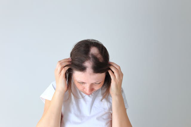 Real alopecia areata in a young girl. A bald head in a person - Image credit: Nadya Kolobova | stock.adobe.com