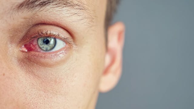 Close up of the red eye of a man affected by an infection, copy space - Image credit: lenblr | stock.adobe.com