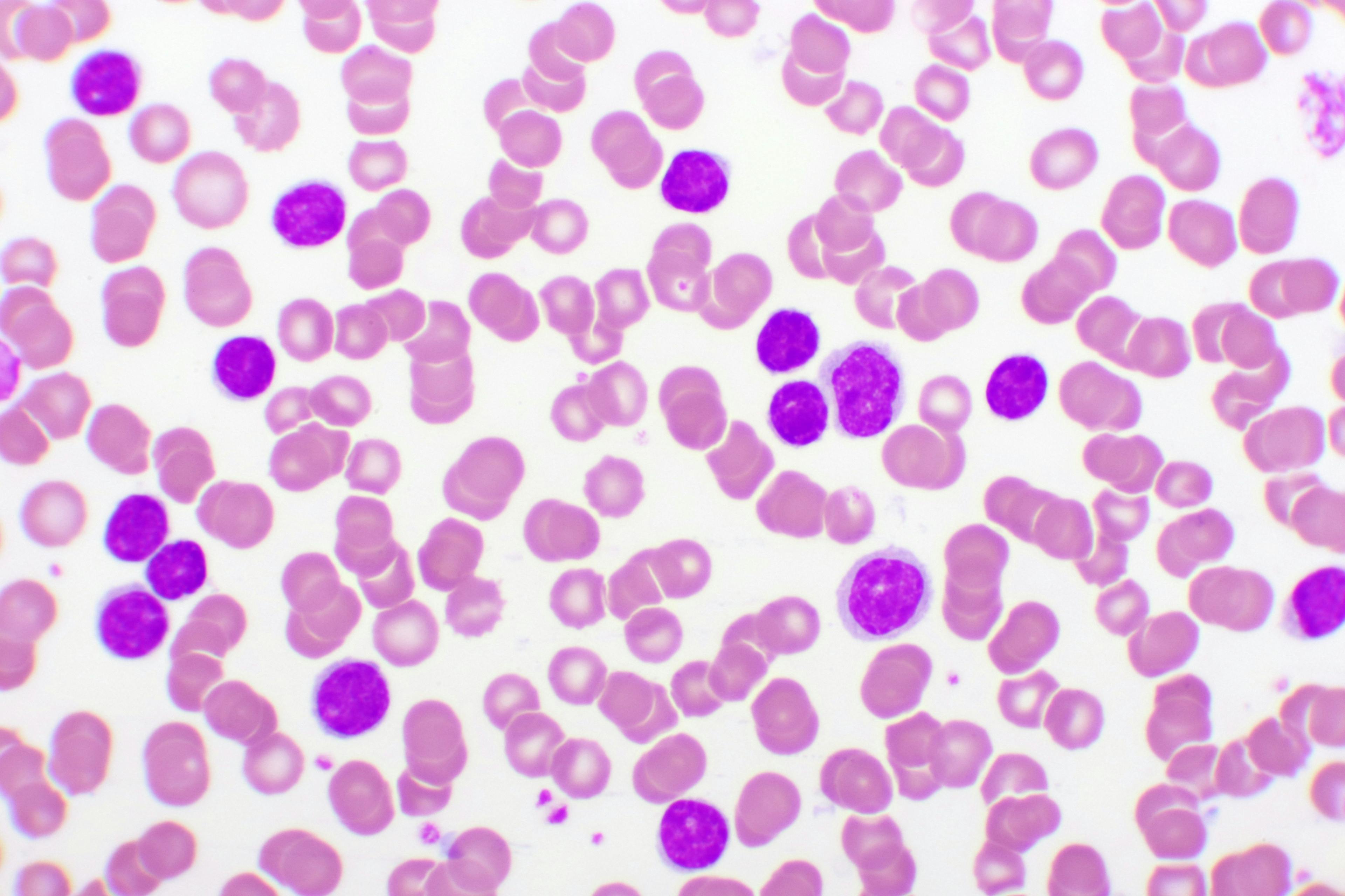 Chronic lymphocytic leukemia -- Image credit: jarun011 | stock.adobe.com