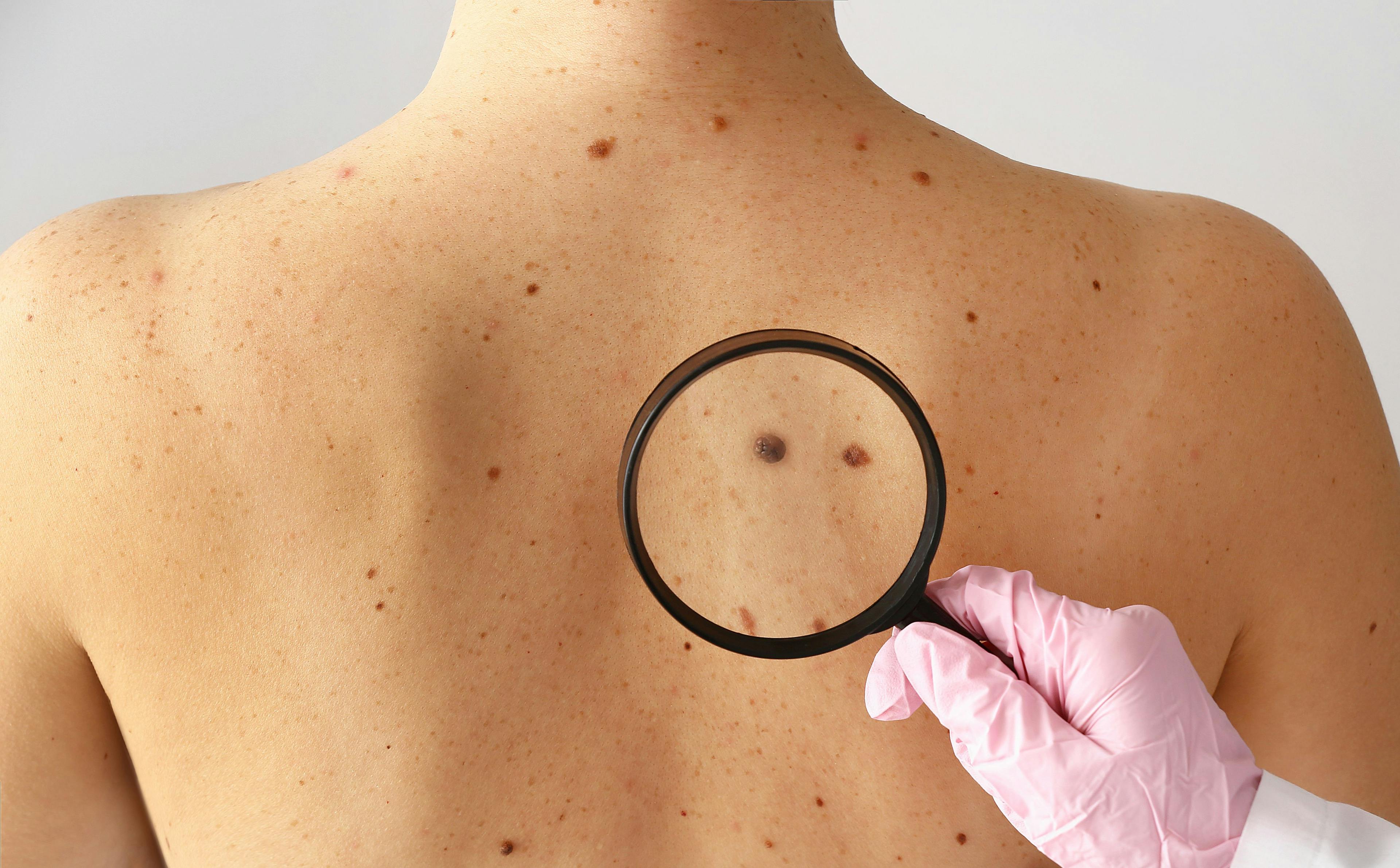 Dermatologist examining moles of patient in clinic. Credit: Pixel-Shot - stock.adobe.com