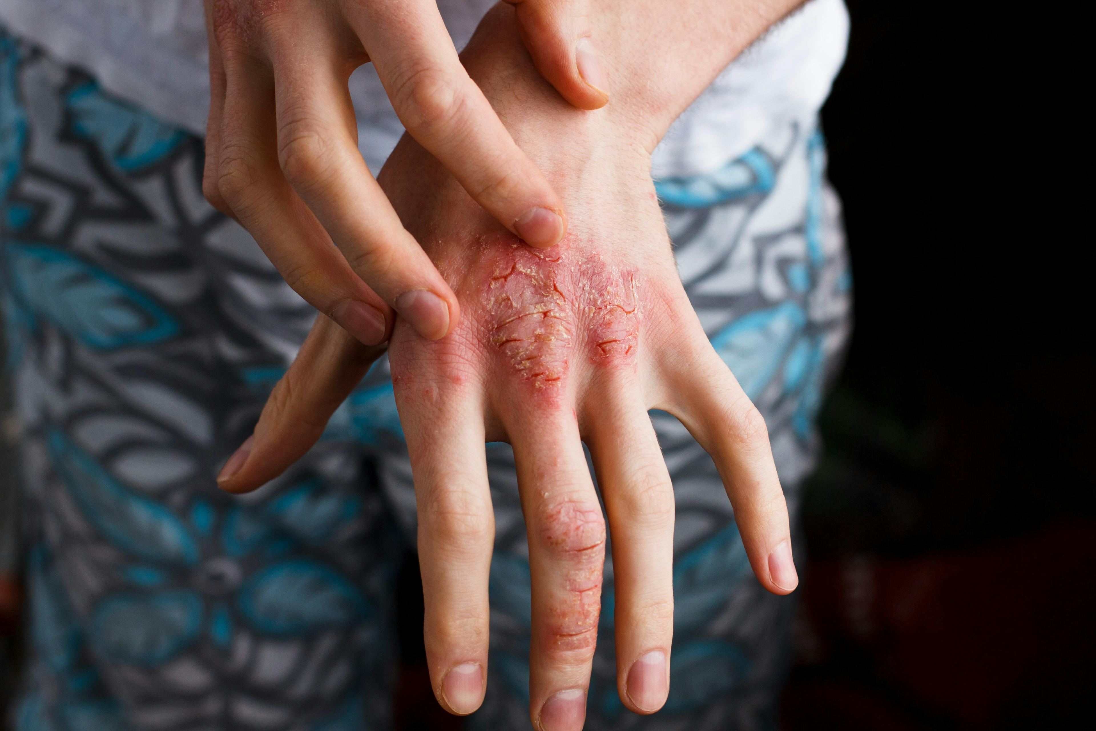 Skin infection on hand