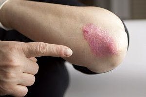 Mutated CARD14 Gene Could Lead to Increased Inflammation in Psoriasis 
