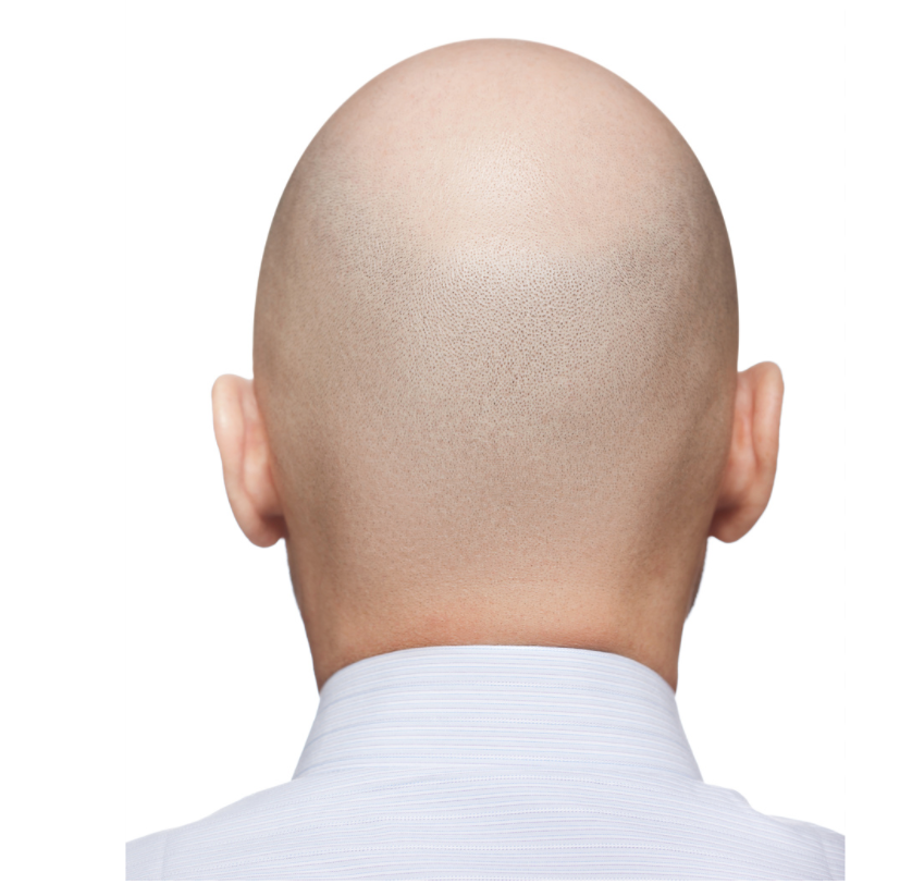 Baricitinib Produces Significant Hair Regrowth in Adults With Severe Alopecia Areata 