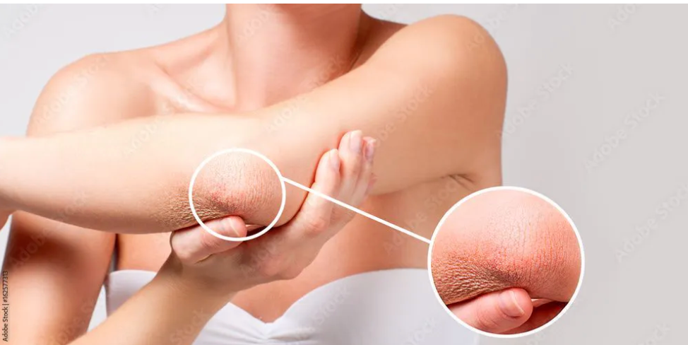 Body care. Woman has dry skin on elbow. - Image credit: Dmytro Flisak | stock.adobe.com


