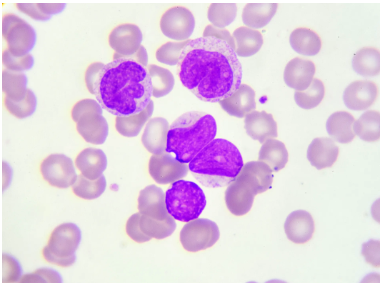 New Manufacturing Process Could Improve CAR T Cell Efficacy Against Aggressive Form of Leukemia