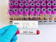 Hepatitis C Testing Guidelines Leave Many Undiagnosed