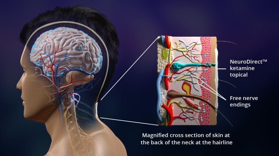 How Ketamine Topical Works: Applied to the back of the neck at the hairline, ketamine topical activates receptors on free nerve endings, inducing neurochemical reactions which transmit nerve action potentials to the brain. Image Credit: © Psycheceutical Bioscience