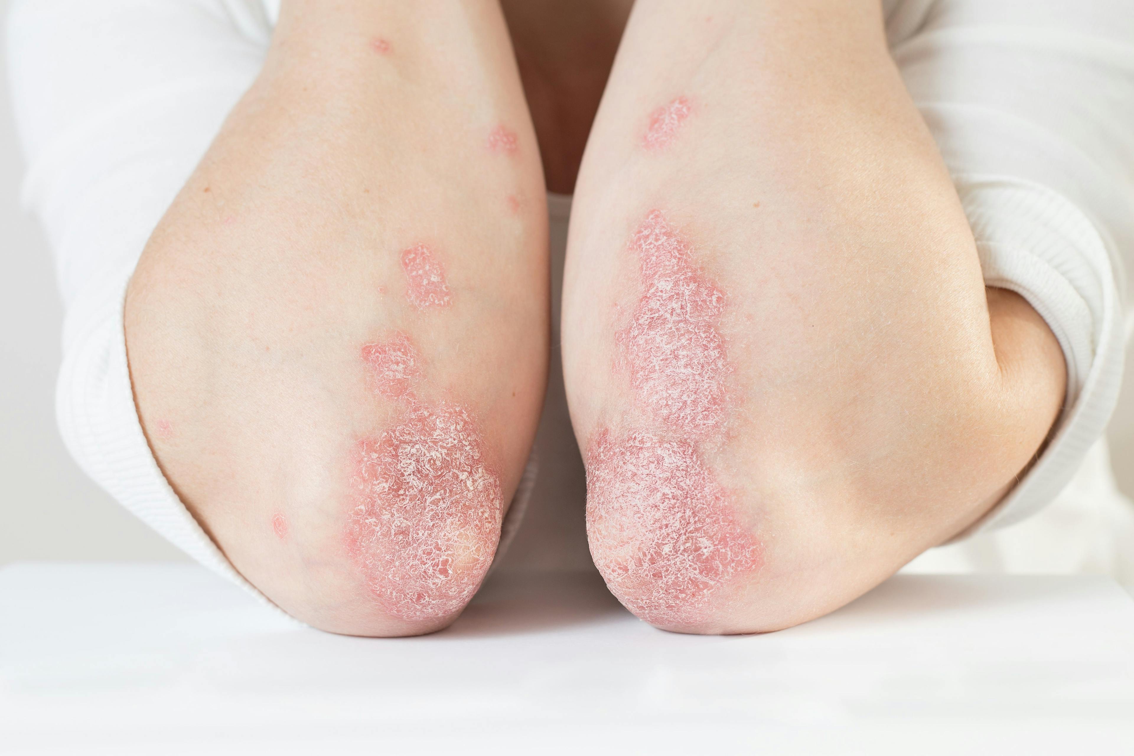 Acute psoriasis on the elbows is an autoimmune incurable dermatological skin disease. Large red, inflamed, flaky rash on the knees. Joints affected by psoriatic arthritis | Image Credit: SNAB - stock.adobe.com