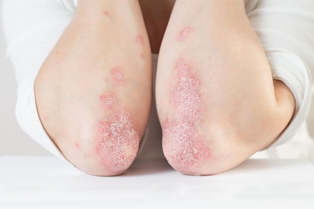 Acute psoriasis on the elbows is an autoimmune incurable dermatological skin disease | Image Credit: SNAB - stock.adobe.com