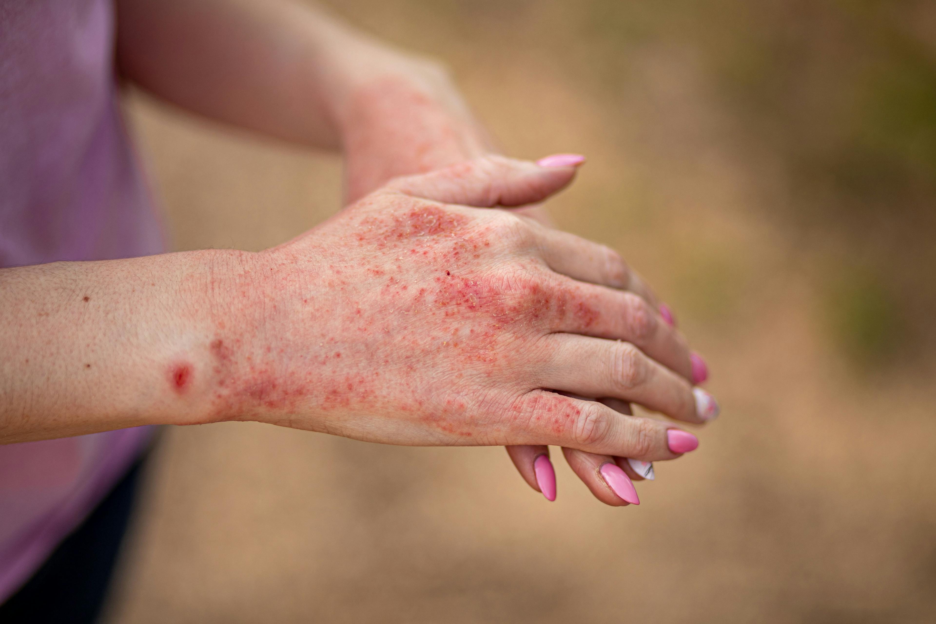 Close up dermatitis on skin, ill allergic rash eczema skin of patient, atopic dermatitis symptom skin detail texture | Image Credit: Irina - stock.adobe.com