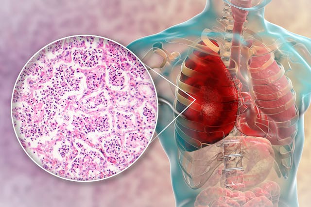 Lobar pneumonia, red hepatic phase, 3D illustration and light micrograph | Image Credit: Dr_Microbe - stock.adobe.com