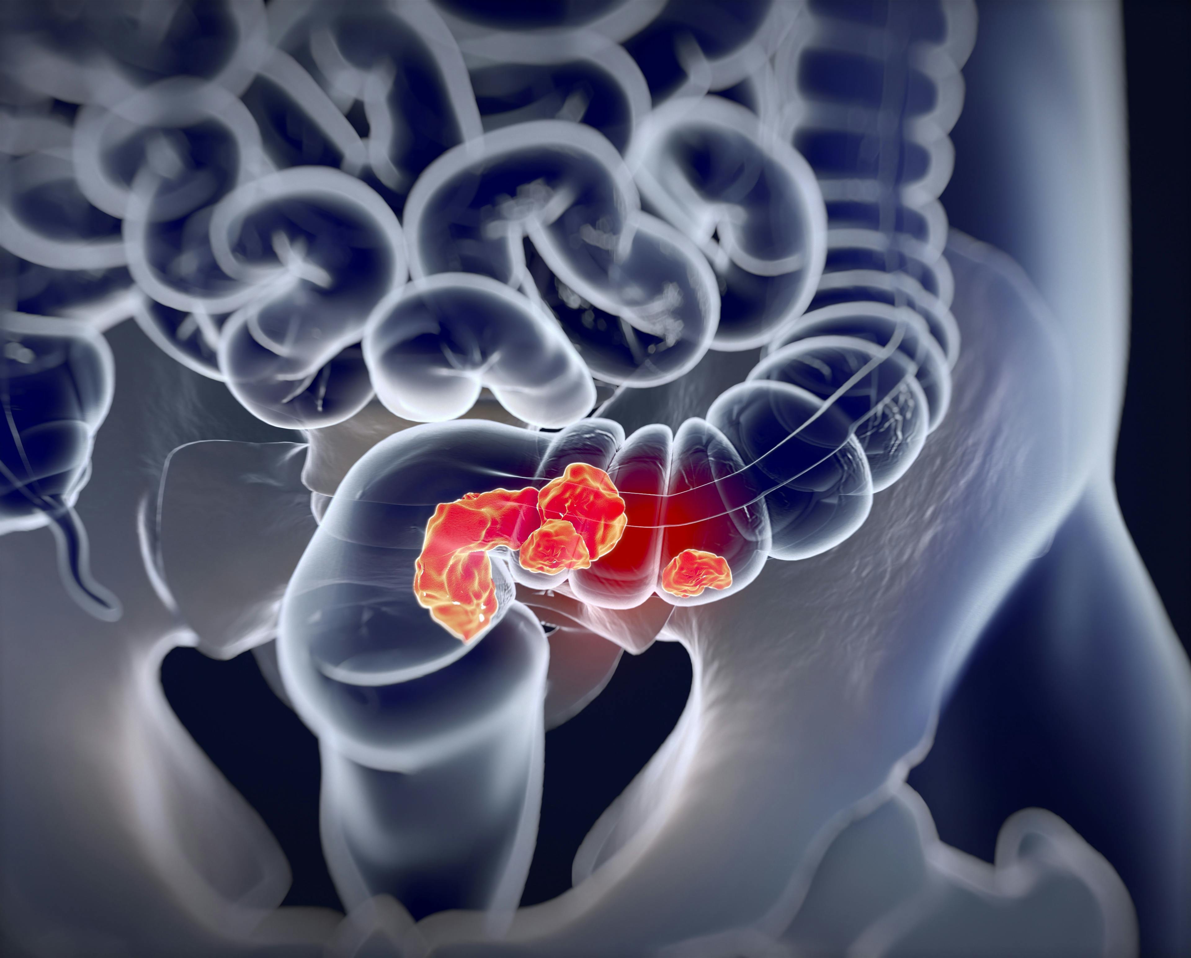 Immunotherapy May Be Effective In Certain Patients With Metastatic Colorectal Cancer