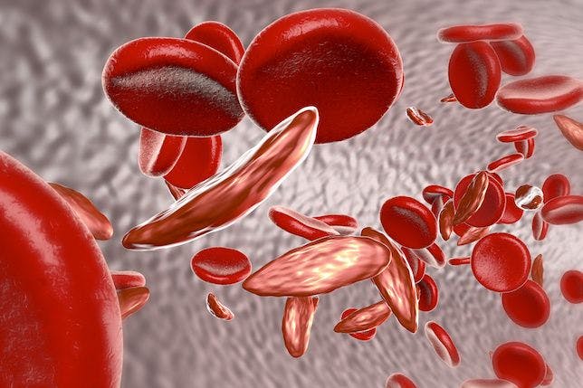 Sickle Cell Anemia Has Multiple Treatment Options