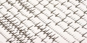 The New Atrial Fibrillation Guidelines: An In-Depth Guide