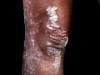 Guselkumab Shows Superiority in Severe Plaque Psoriasis