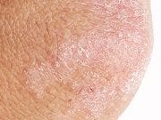 Early Treatment Effective in Infants with Atopic Dermatitis